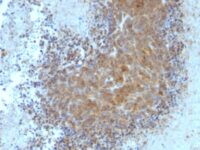 FFPE human melanoma sections stained with 100 ul anti-Bax (clone BAX/962) at 1:100. HIER epitope retrieval prior to staining was performed in 10mM Tris 1mM EDTA, pH 9.0.